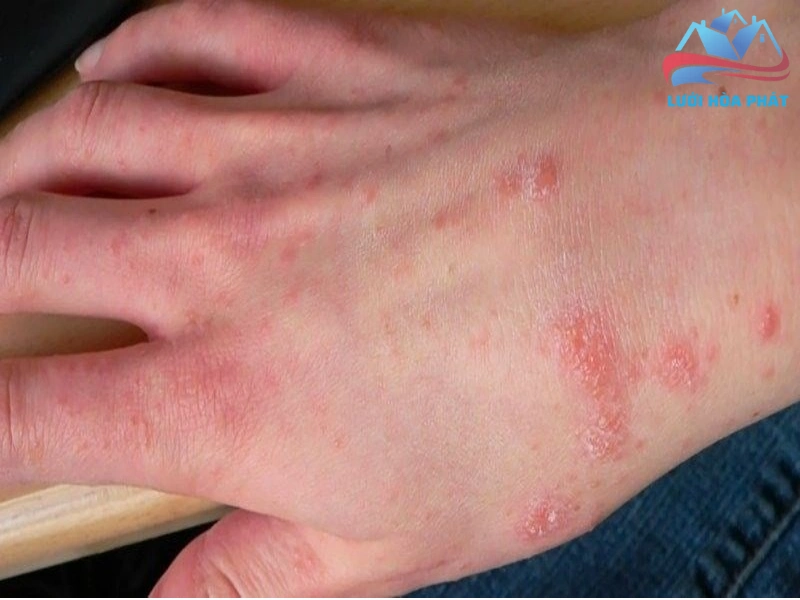 Rủi ro về da liễu và môi trường